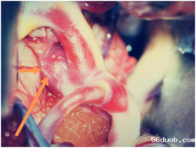 “不定时炸弹”脑动脉瘤